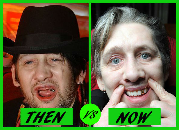 shane macgowan then v now dental implants